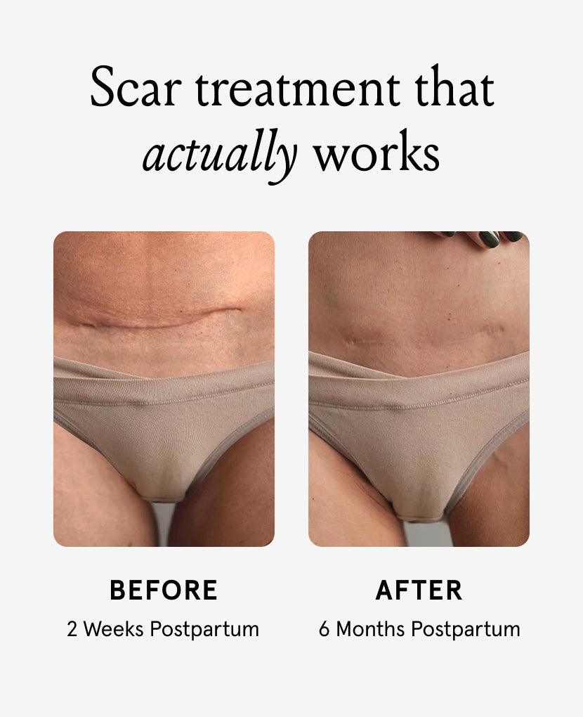 Side-by-side photos show a person’s lower abdomen before and after using Renewing Scar Cream. Left: Before, 2 Weeks Postpartum; Right: After, 6 Months Postpartum. The scar appears less visible in the after image.